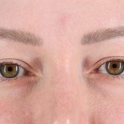 Eyelid Surgery Before & After Patient #1990