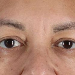 Eyelid Surgery Before & After Patient #2001