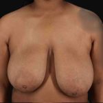 Breast Reduction with Lift Before & After Patient #905