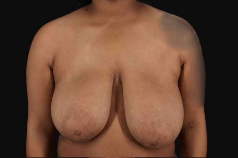 Breast Reduction with Lift Before & After Patient #905