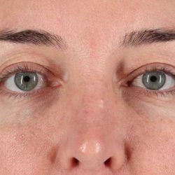 Eyelid Surgery Before & After Patient #2012