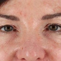 Eyelid Surgery Before & After Patient #2034