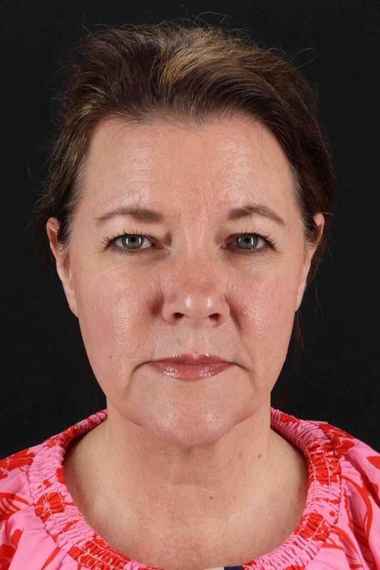 Laser Before & After Patient #2037