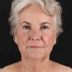 CO2 Laser Before & After Patient #2048