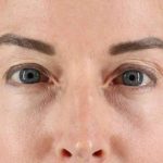 CO2 Laser Before & After Patient #2070