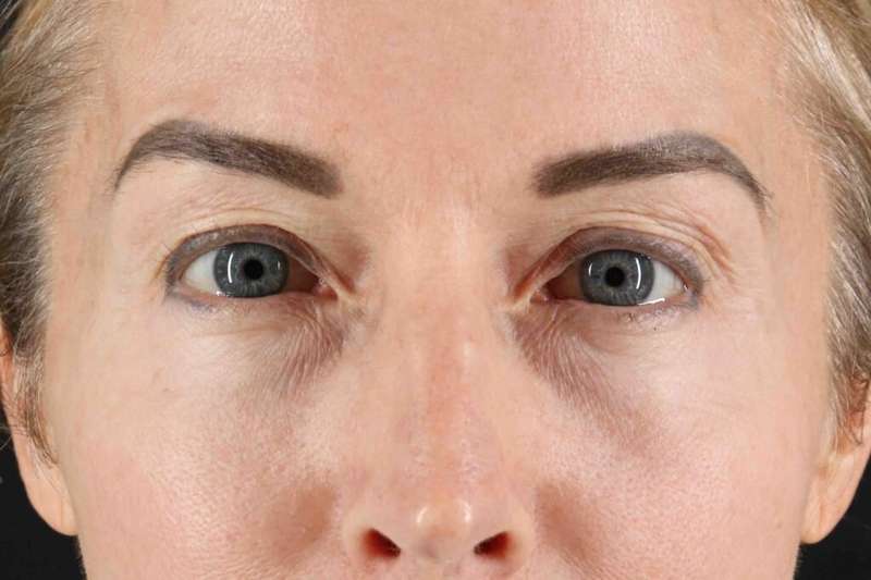 Laser Before & After Patient #2070