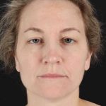 CO2 Laser Before & After Patient #2081