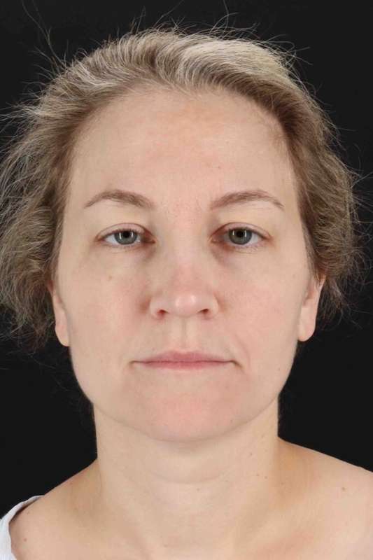 Laser Before & After Patient #2081