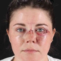 CO2 Laser Before & After Patient #2092