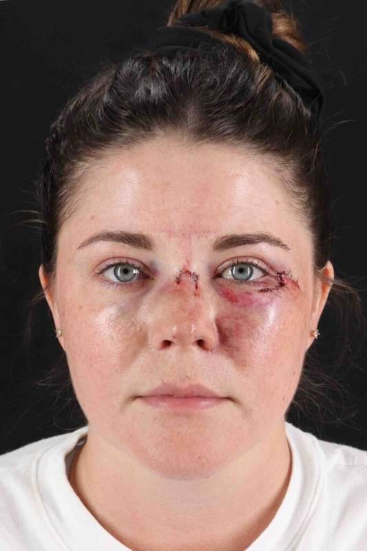 Laser Before & After Patient #2092