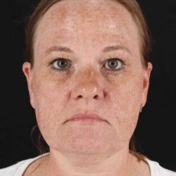 CO2 Laser Before & After Patient #2103