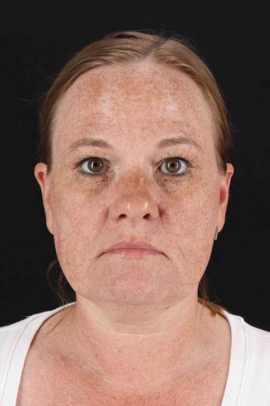 Laser Before & After Patient #2103