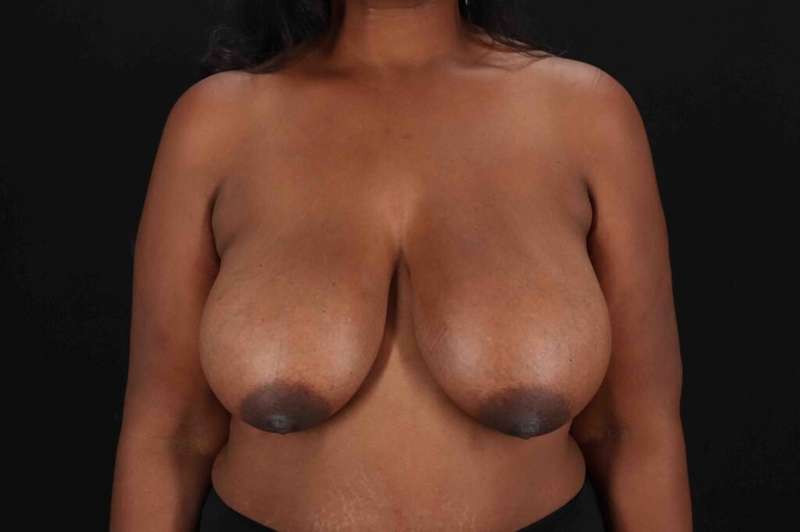 Breast Reduction with Lift Before & After Patient #917