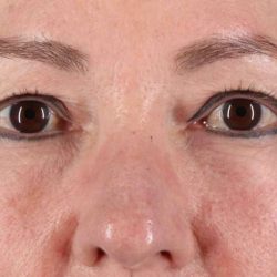 CO2 Laser Before & After Patient #2114