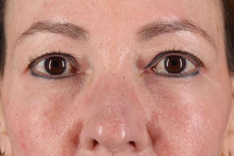 Laser Before & After Patient #2114
