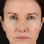 CO2 Laser Before & After Patient #2125