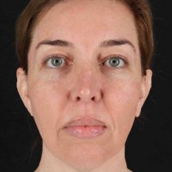 CO2 Laser Before & After Patient #2136