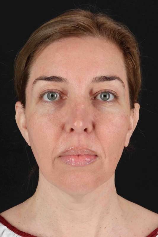 Laser Before & After Patient #2136
