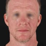 CO2 Laser Before & After Patient #2158