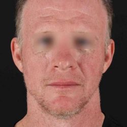CO2 Laser Before & After Patient #2158