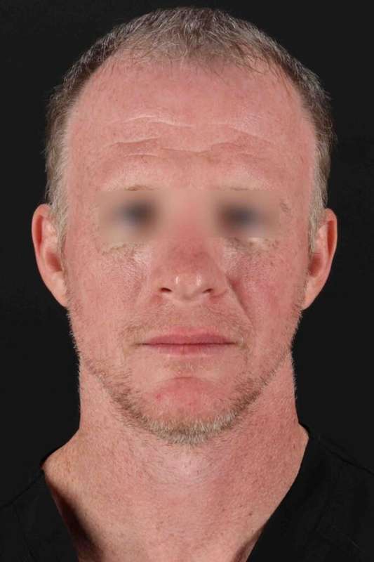 Laser Before & After Patient #2158