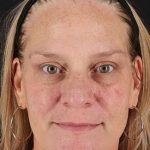 Chemical Peel Before & After Patient #2169