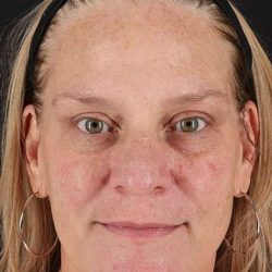 Chemical Peel Before & After Patient #2169