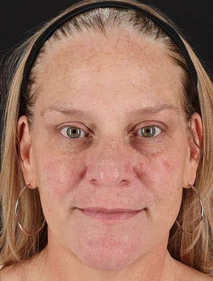 Chemical Peel Before & After Patient #2169