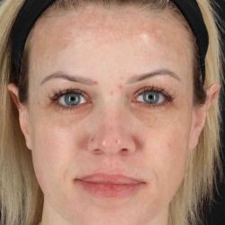 Chemical Peel Before & After Patient #2180