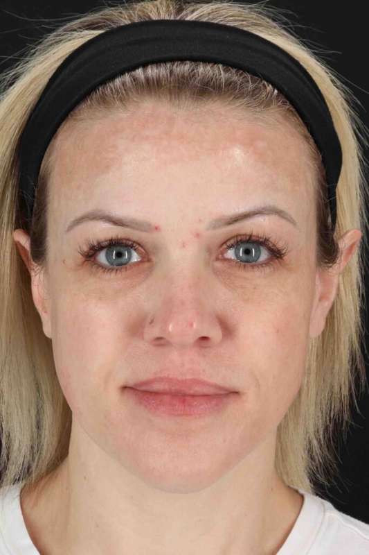 Chemical Peel Before & After Patient #2180