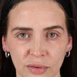 Chemical Peel Before & After Patient #2202