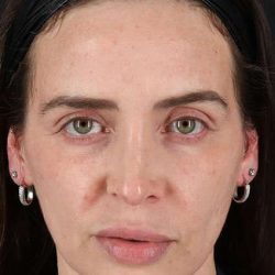 Chemical Peel Before & After Patient #2202