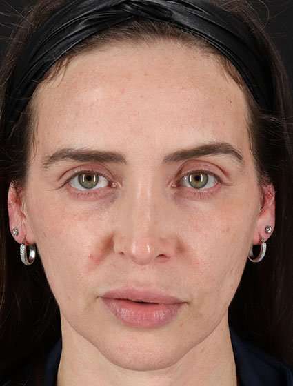 Chemical Peel Before & After Patient #2202
