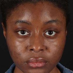 Chemical Peel Before & After Patient #2213
