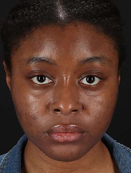 Chemical Peel Before & After Patient #2213