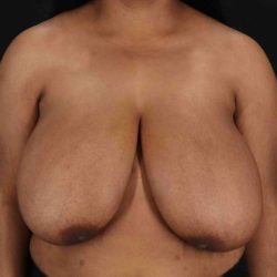 Breast Reduction with Lift Before & After Patient #928