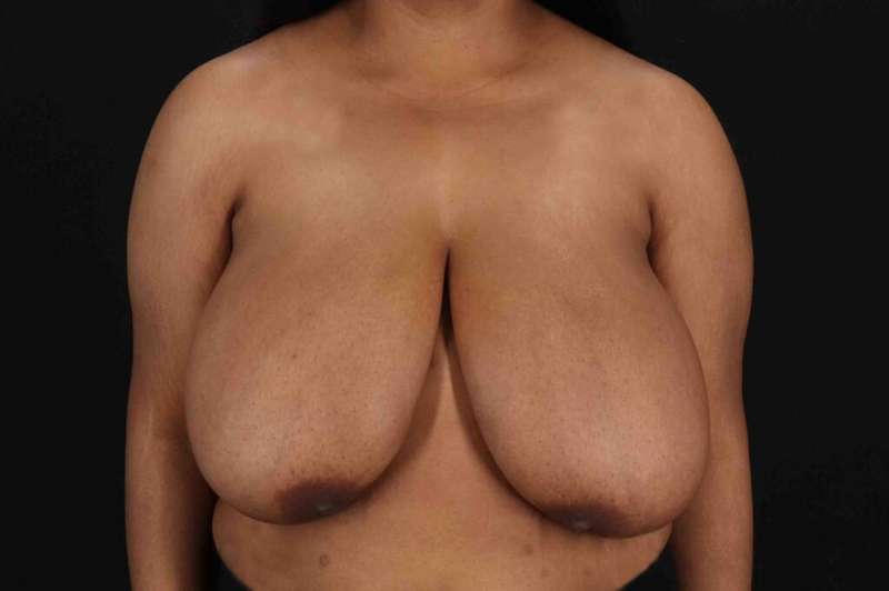 Breast Reduction with Lift Before & After Patient #928