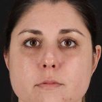 Chemical Peel Before & After Patient #2216