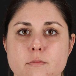 Chemical Peel Before & After Patient #2216