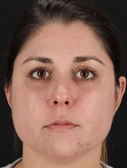 Chemical Peel Before & After Patient #2216