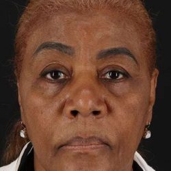 Chemical Peel Before & After Patient #2227