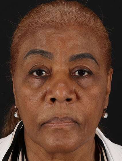 Chemical Peel Before & After Patient #2227