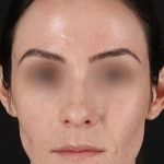 Cosmetic Injectables Before & After Patient #2236