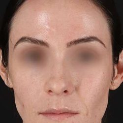 Cosmetic Injectables Before & After Patient #2236