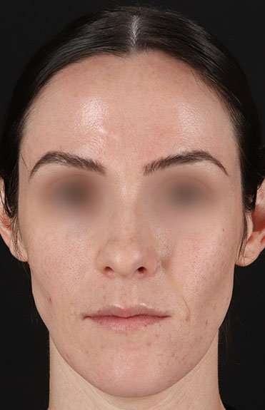 Cosmetic Injectables Before & After Patient #2236