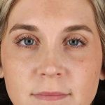 Cosmetic Injectables Before & After Patient #2239