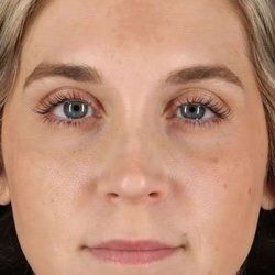 Cosmetic Injectables Before & After Patient #2239