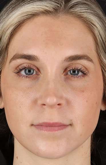 Cosmetic Injectables Before & After Patient #2239