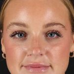 Cosmetic Injectables Before & After Patient #2242
