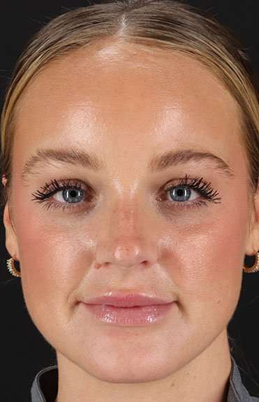 Cosmetic Injectables Before & After Patient #2242
